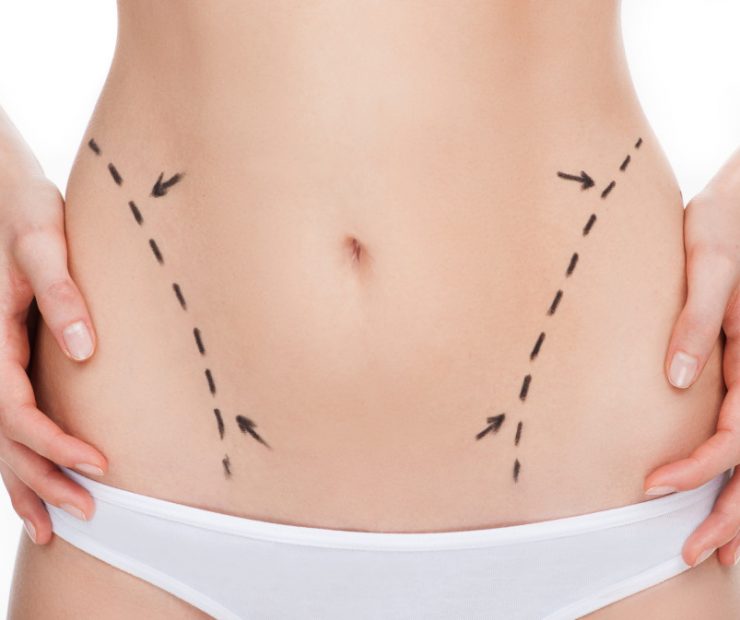 Liposuction Surgery in Canada